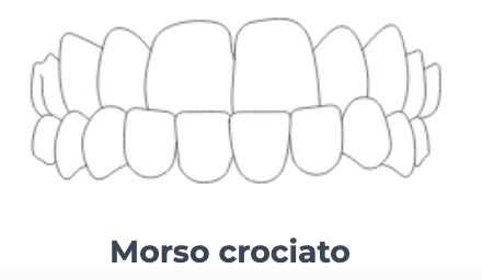 Morso crociato - Ortodonzia Conegliano